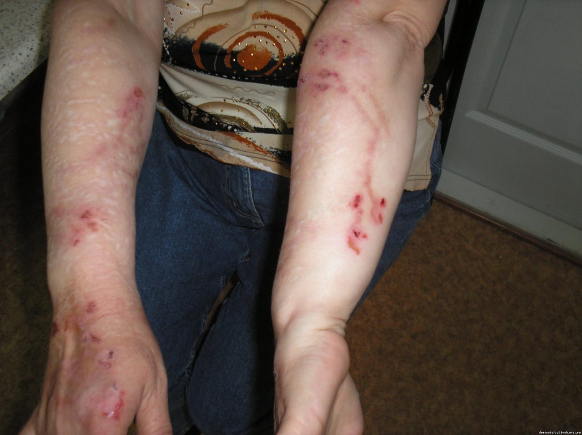 Повреждения кожи рук при патомимии