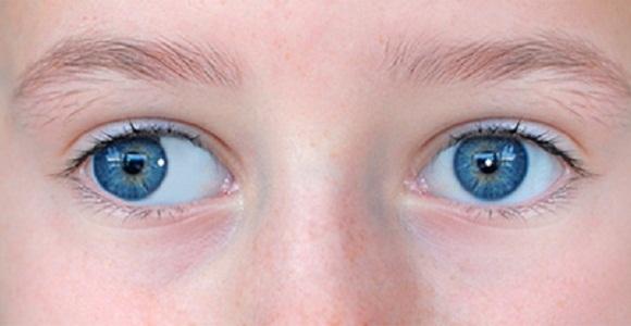 При альтернирующем косоглазии оба глаза косят поочередно