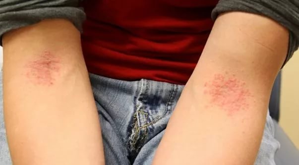 При длительном течении заболевания повышается вероятность присоединения вторичной инфекции