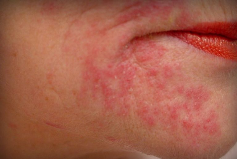 При периоральном дерматите высыпания на коже сливаются
