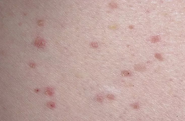 Псевдомонадный фолликулит можно спутать с болезнью Гровера