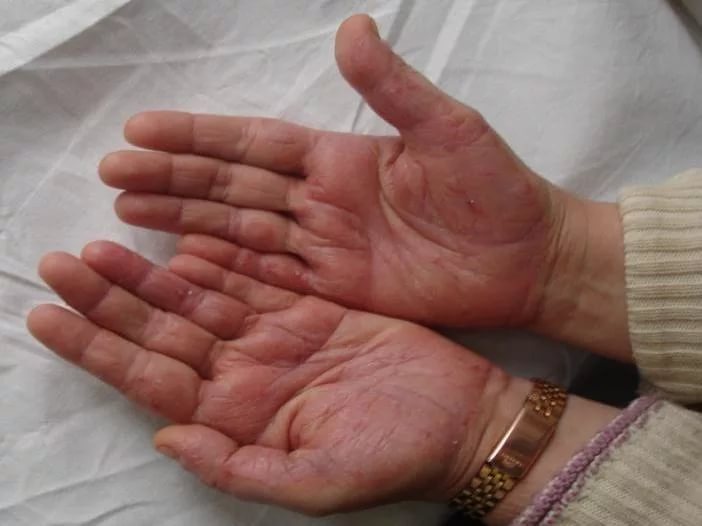 Пустулезный псориаз чаще встречается у лиц с эндокринными нарушениями