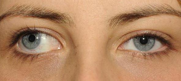 Расходящееся косоглазие может быть следствием неудачной операции на глазах