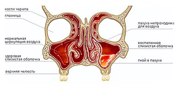 Симптомы синусита