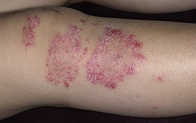 В детском возрасте монетовидная экзема чаще возникает на фоне воспалительных заболеваний инфекционного характера