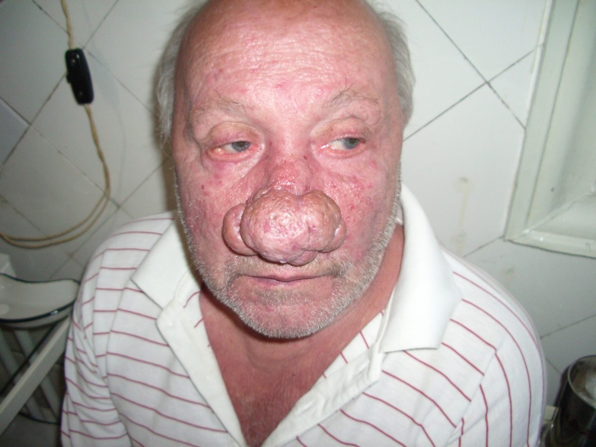 В запущенной форме склерома верхних дыхательных путей выглядит именно так