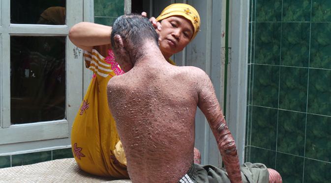 Заболевание носит врожденный характер и не поддается 100%-излечению