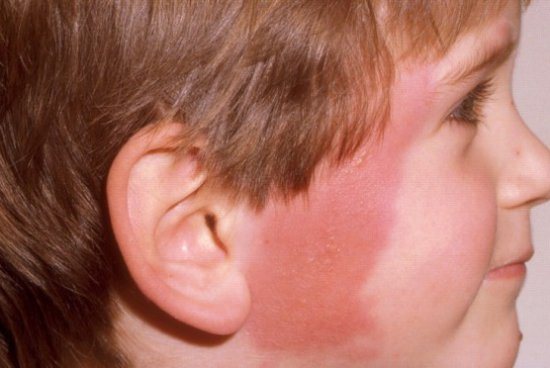 Заболевание редко возникает самостоятельно, а воспалительный процесс часто начинается на соседних тканях.