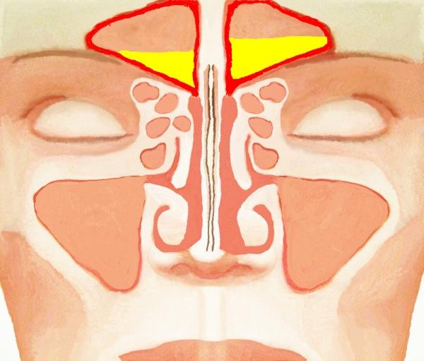 Заполненные гноем лобные синусы при фронтите