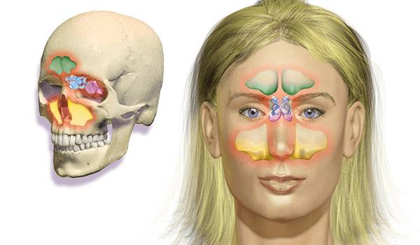 Зубная боль при гайморите