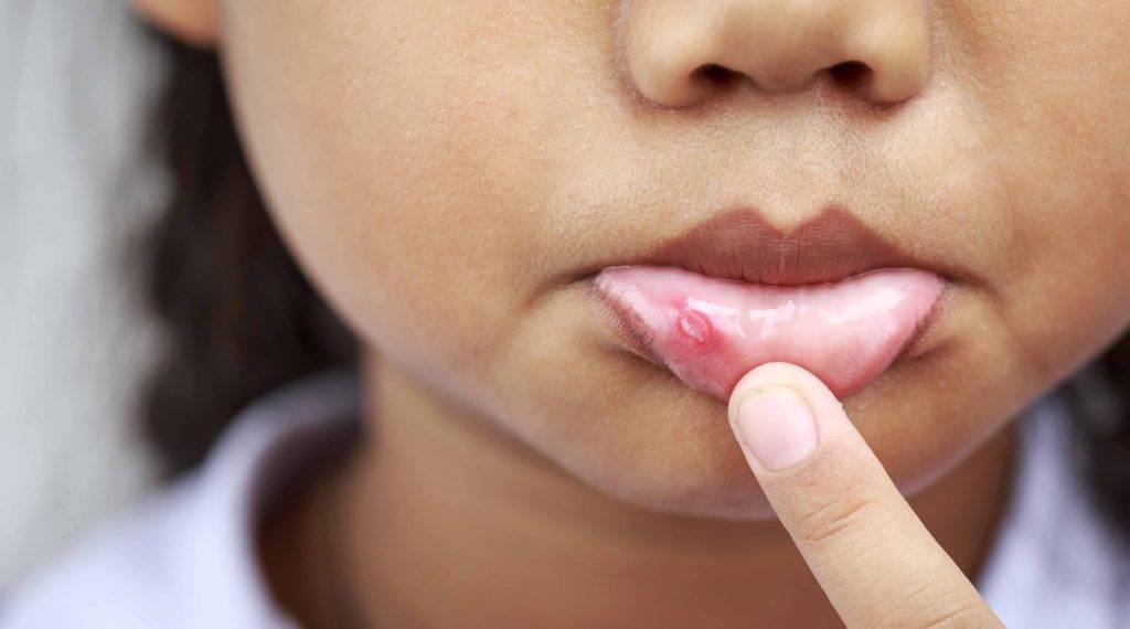 афтозный стоматит у ребенка