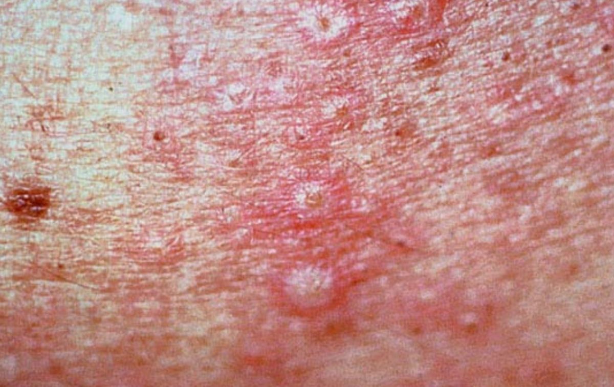 Споротрихоз на коже