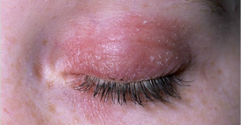 Поражение век грибком Кандида