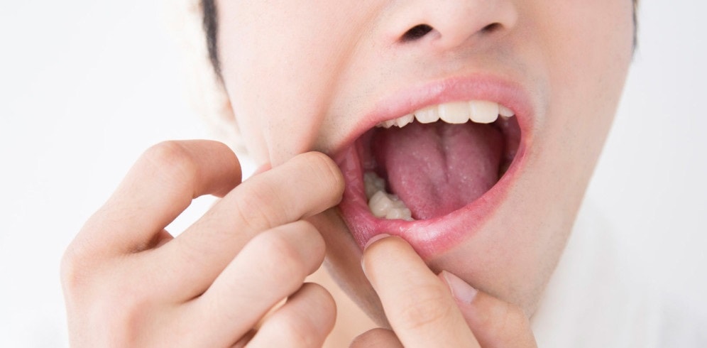 афтозный стоматит