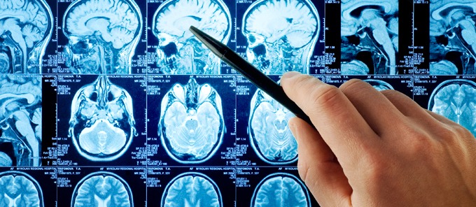 Снимок головного мозга при неврологических нарушениях