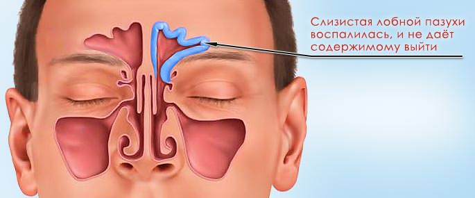 Если вылечить фронтит с помощью антибиотиков не удается, осуществляют прокол