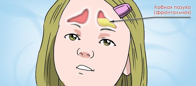 Лобная пазуха заполненная гноем при фронтите у детей