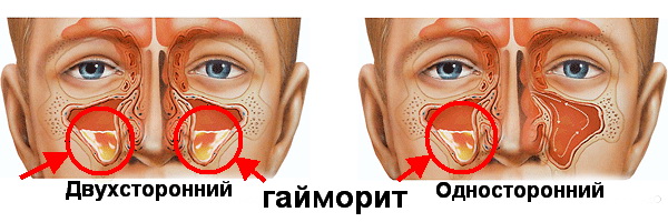 Двухсторонний гайморит: виды, симптомы и отличия