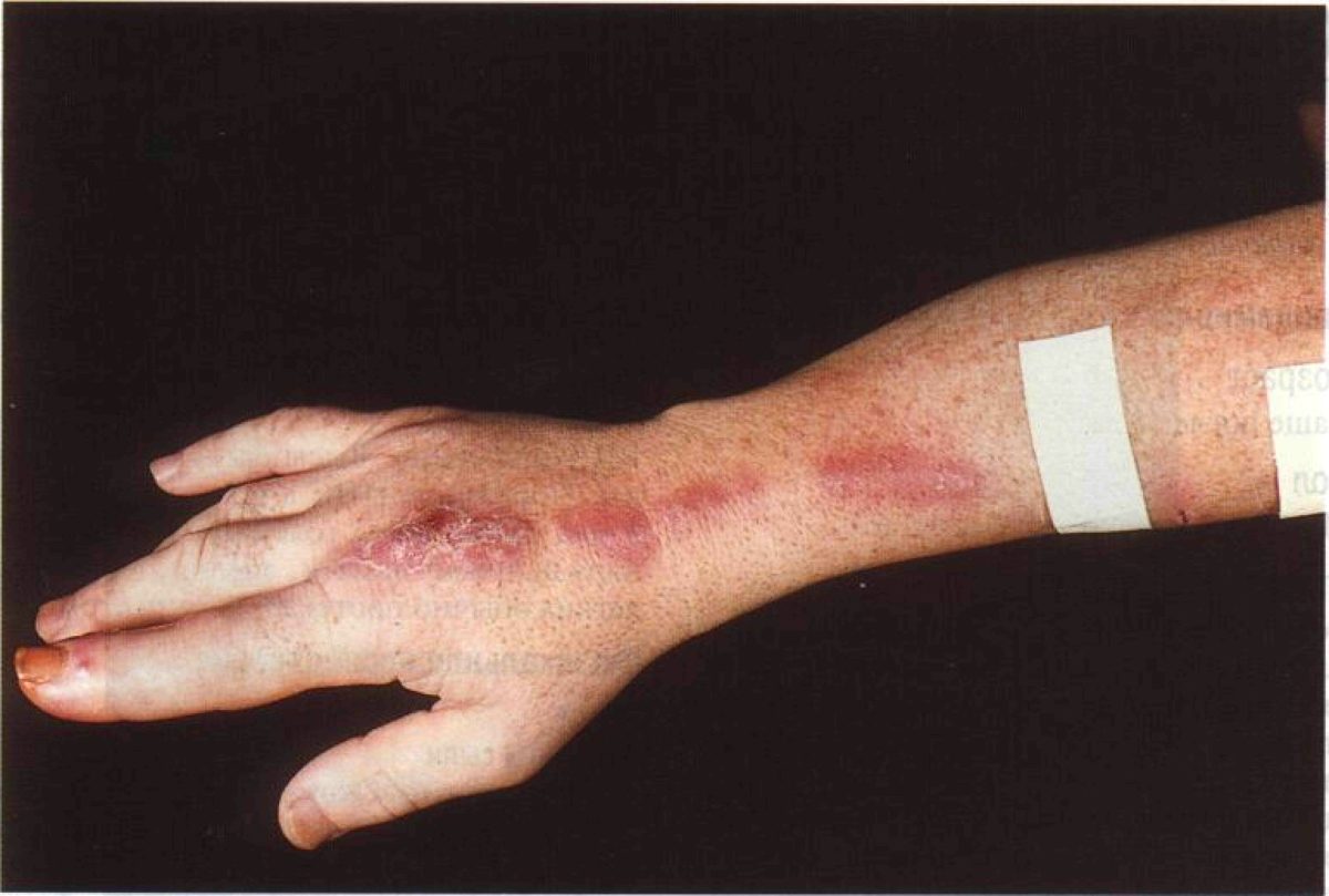 Поражение кожи рук споротрихозом