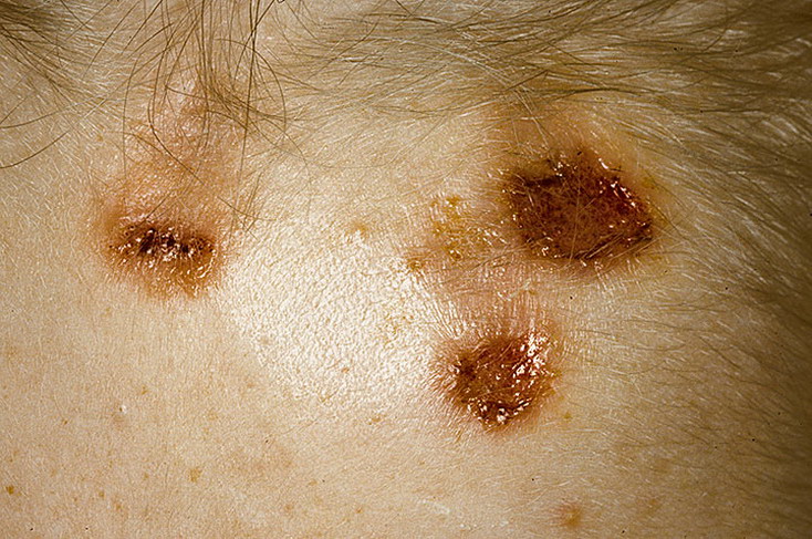 Раны на коже при расчесывании