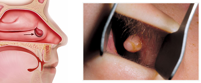 Полипы в носу на схеме и фото