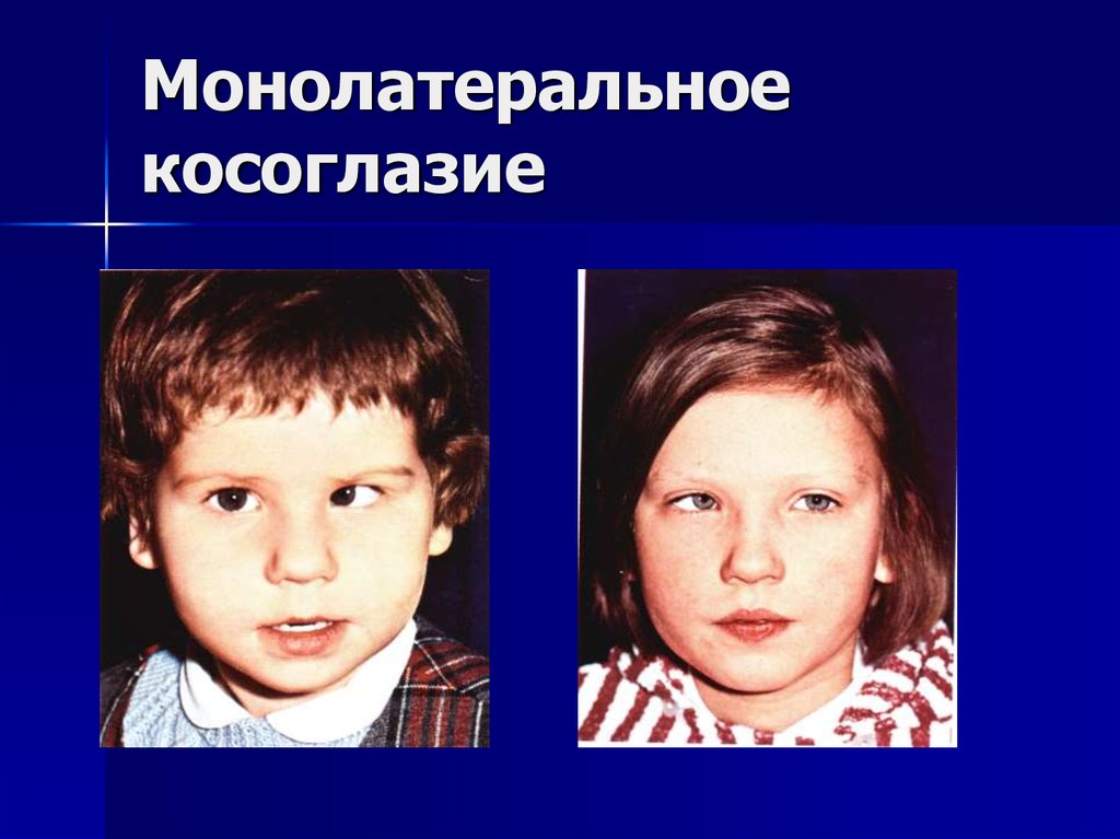Монолатеральное косоглазие известно так же, как односторонний страбизм