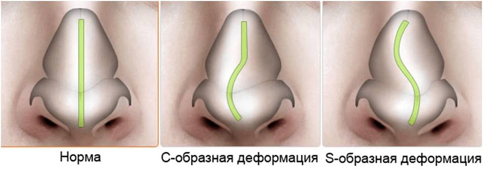 Виды искривления носовой перегородки