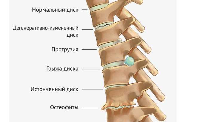 Карипазим назначают при грыже межпозвоночных дисков, остеохондрозе всех отделов позвоночника, радикулите