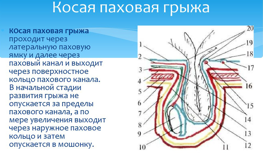 Косая грыжа это когда мешок по ямке паха оказывается снаружи