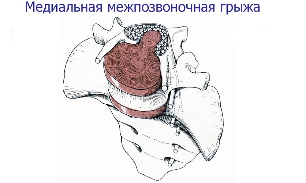 Если выпячивание межпозвоночного диска направлено вперед или назад по осевой линии диска, то такая грыжа называется медианной