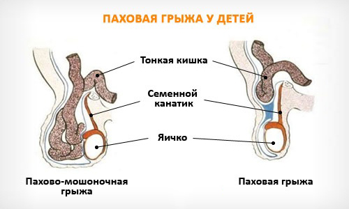 Паховая грыжа у новорожденных - широко распространенная хирургическая патология, характеризующаяся выпадением внутренних органов через расширенный паховый канал