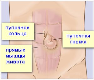 Umbilical-hernia-surgery