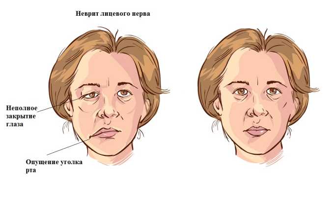 Карипазим применяется при неврите лицевого нерва