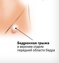 bedrennaya-grizha