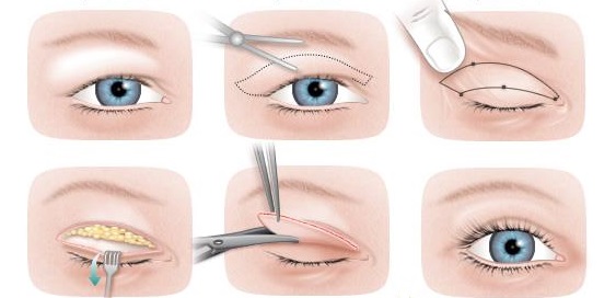 blefaroplastika