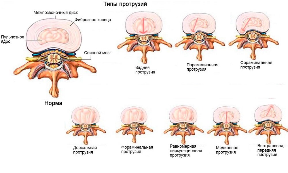 Принято считать выпирание диска размером до 3 мм протрузией, более 6 мм - грыжей