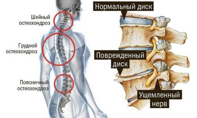 Электрофорез с карипазимом назначают при остеохондрозе