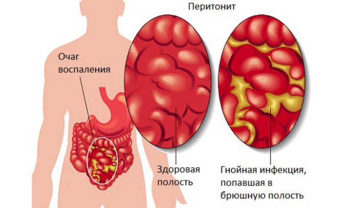 Заболевания инфекционного характера являются противопоказанием к мануальное терапии