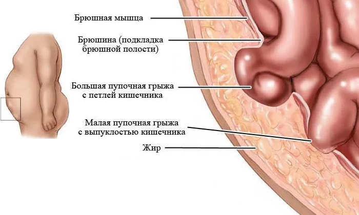 Параумбиликальная грыжа — это патологическое состояние, характеризующееся выпячиванием органов брюшной полости в область пупочного кольца