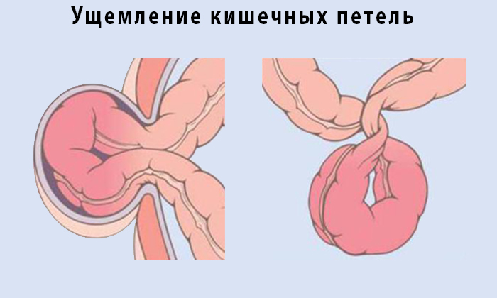 Кишечной непроходимостью называют состояние, при котором нарушается или полностью прекращается движение химуса по кишечнику