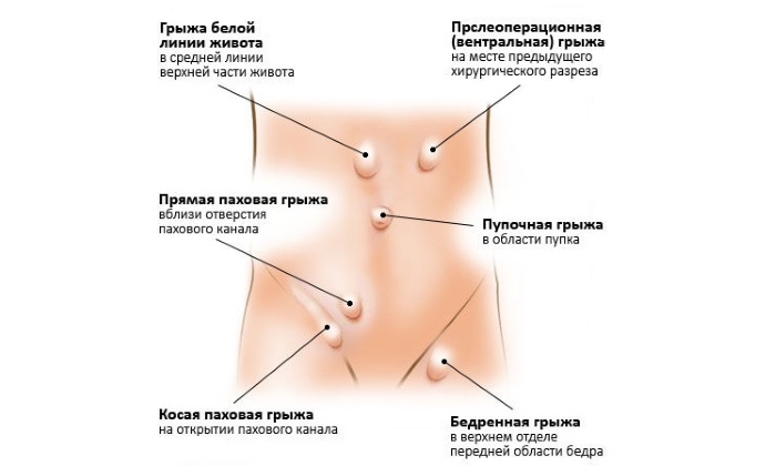Грыжа провоцирует дисфункции органов той системы, где расположен грыжевой мешок