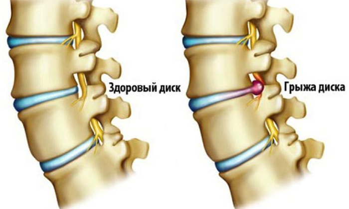 Развитие секвестрированной грыжи является конечным результатом дегенеративно-дистрофического разрушения фиброзного кольца межпозвоночного диска