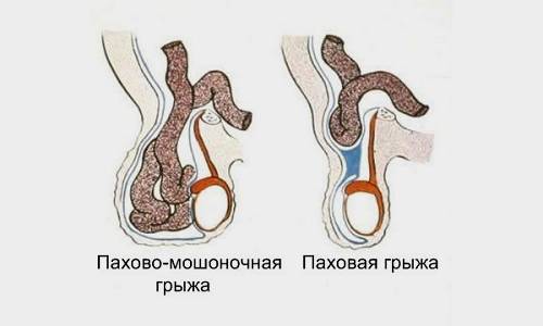 В зависимости от локализации различают пахово-мошоночную грыжу, когда патологический процесс затрагивает мошонку и располагается на уровне яичек