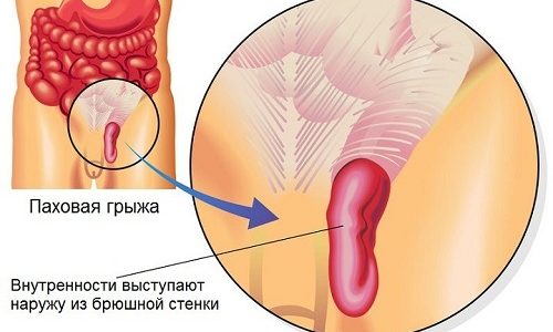 Ущемленная паховая грыжа — постепенное или резкое сдавливание органа брюшной полости в области паха, при котором нарушается кровообращение в поврежденном участке, что в дальнейшем может привести к его отмиранию