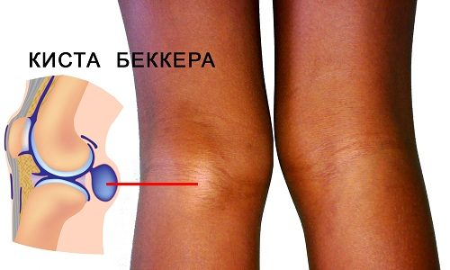 Грыжа Беккера — воспалительный процесс в суставной сумке, в результате которого жидкость, образующаяся в результате отека, проникает между сухожилиями