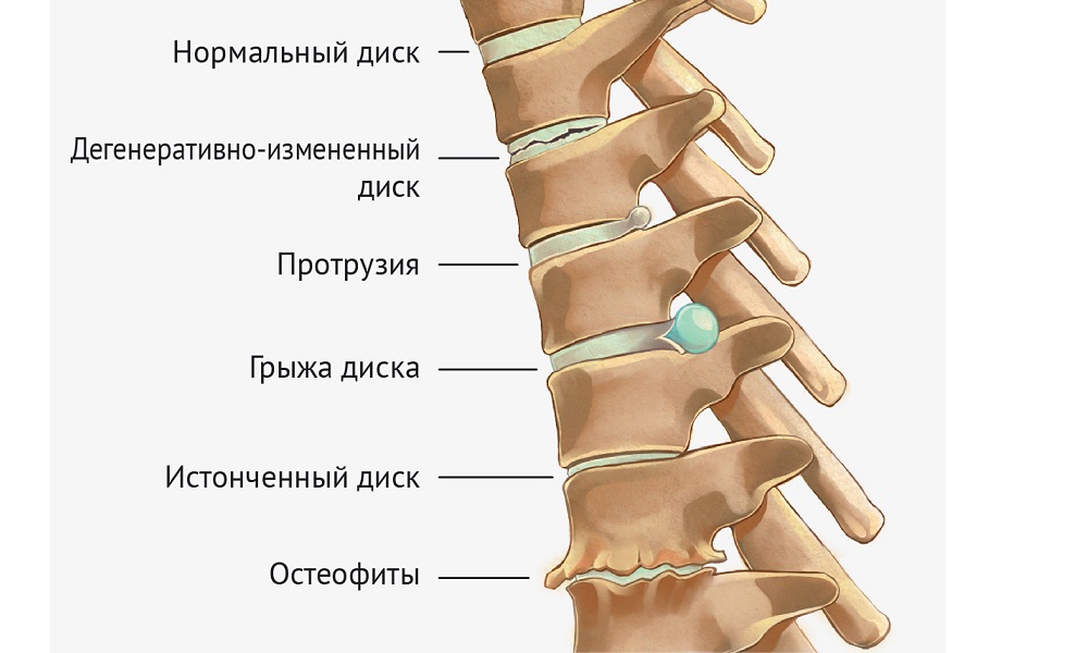 Межпозвонковая грыжа - это достаточно распространенное патологическое состояние опорно-двигательного аппарата, при котором внутреннее содержимое пораженного диска выпирает в спинномозговой канал, зажимая нервные окончания и принося сильнейшие боли