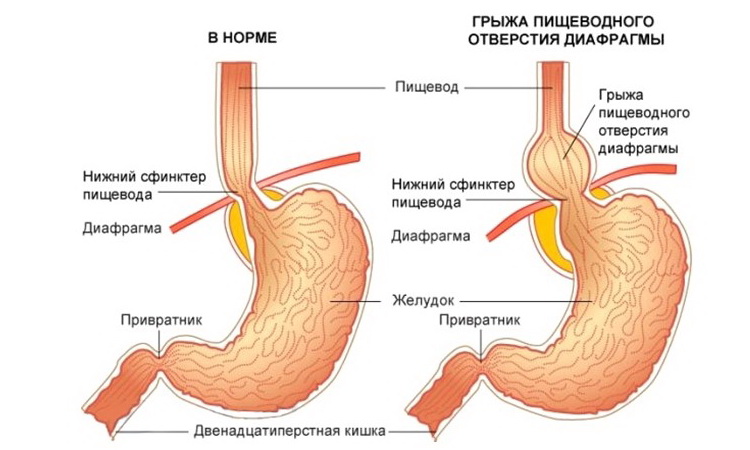 Грыжа пищеводного отверстия диафрагмы наиболее часто встречается у людей старше 50 лет с избыточной массой тела