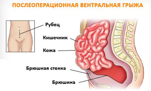 Вентральная грыжа возникает после хирургического вмешательства