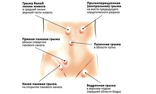 Схема классификации брюшных грыж