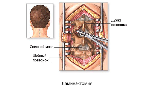 Ламинэктомия - операция, во время которой полностью или частично удаляют дужку пораженного позвонка